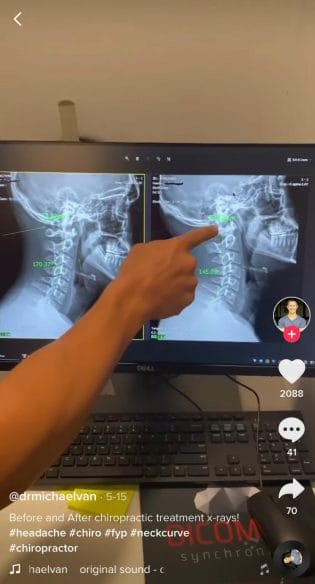 before and after videos for tiktok for chiropractors