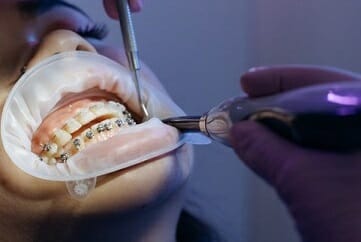 orthodontic procedure