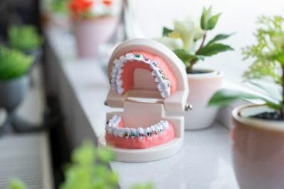 Teeth model with braces featured in an orthodontic blog